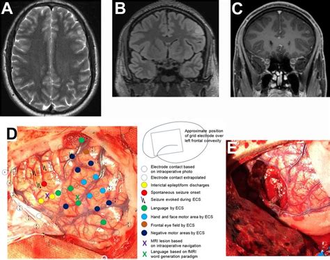 Brain Tumor In The Left Middle Frontal Gyrus With Cortical And