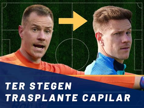 Ter Stegen: Trasplante Capilar