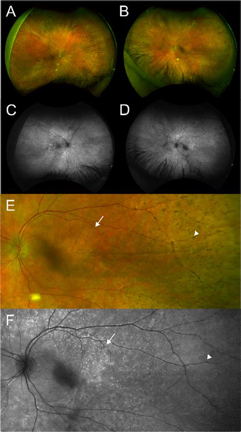 Fundus Imaging Ultra Widefield Uwf Pseudo Color Images Demonstrate