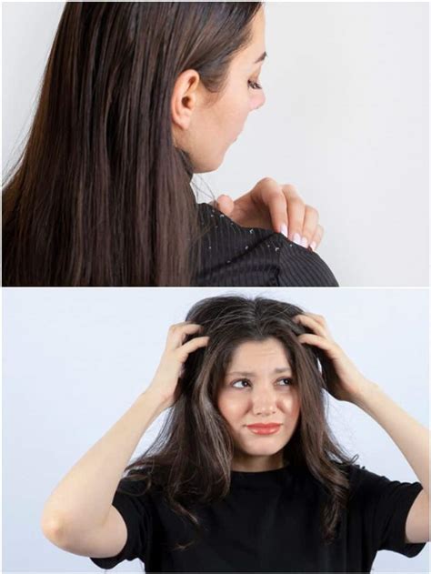 Winter Hair Care 7 Practices To Avoid For Dandruff Free Locks