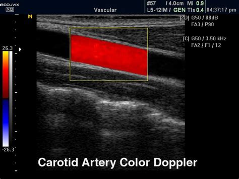 Carotid Doppler Ultrasound