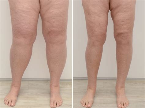 Conheça o lipedema a doença que pode atingir mais de 10 das mulheres