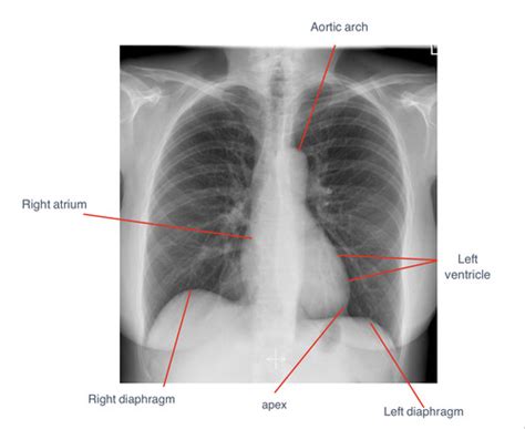 Chest X Ray Flashcards Quizlet