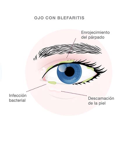 Qu Es La Blefaritis Coru A Visi N Cl Nica Ocular Oftalmol Gica