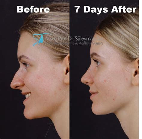 Celebrity nose job: before and after | Nose job, Rhinoplasty, Bad nose jobs