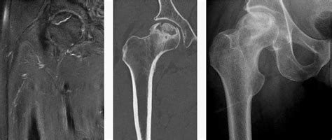 Collapsed Femoral Head