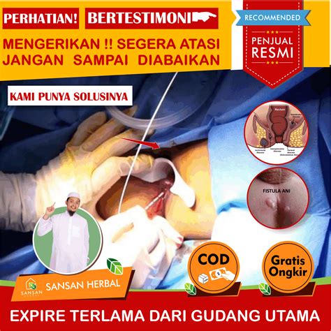 Gambar Fistula Ani