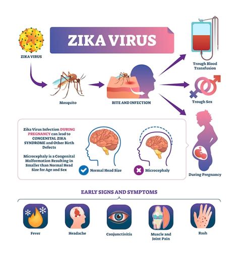 Ilustraci N De Vector De Virus Zika Esquema De Signos Y S Ntomas De