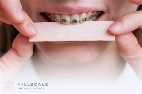 Is Chewing Gum Good For Braces Hillsdale Orthodontics