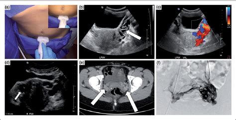 Figure 8 From A Standardized Ultrasound Approach To Pelvic Congestion