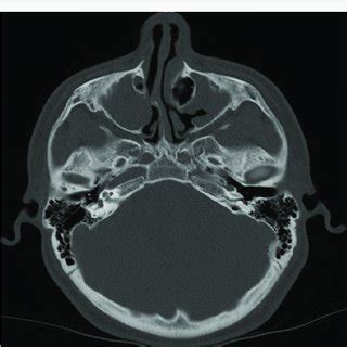 Apparent left maxillary antrostomy that was seen clinically | Download ...