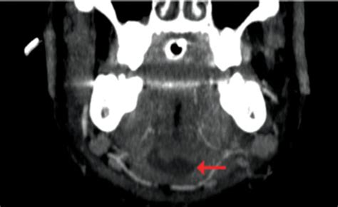 Ludwigs Angina A Case Report Oral Health Group