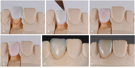 The Human Role in Digital Dental Technology: From Artistry to