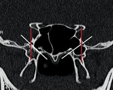 Foramen Rotundum