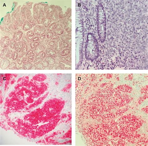 A HE Stain 100x Colonic Polyp With Serrated Configuration And Basal