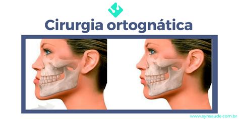 Quanto Custa Uma Cirurgia Ortogn Tica Syn Democratizando O Acesso