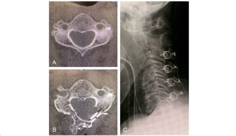 Example Of A Case Of Open Door Laminoplasty Using Titanium Plate