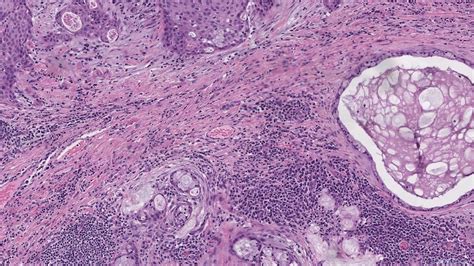 Mucoepidermoid Carcinoma Ottawa Atlas Of Pathology