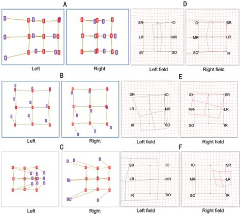 Diplopia Charts Of Computerized Diplopia Test And Hess Screen Test A C