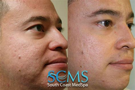 Acne Scar Removal South Coast Med Spa