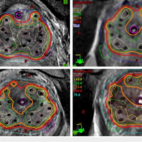 Examples Of Hdr Brachytherapy Dosimetry Four Upper Left Upper Right