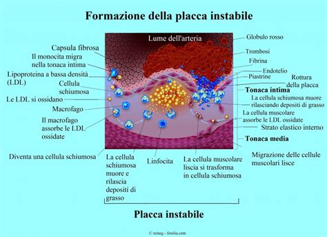 Aterosclerosi E Arteriosclerosi Patogenesi E Cause Conseguenze