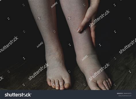 Female Legs Affected By Lymphedema Condition Stock Photo 1884643072 ...