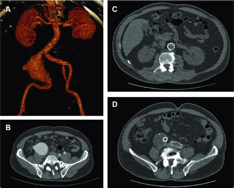 A Preoperative Three Dimensional Reconstruction Of The Patient S