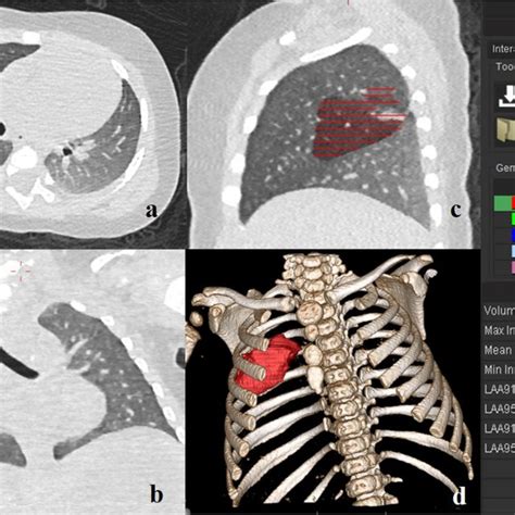 An Example Of Segmentation Of Lung And Each Lobe A Axial View B Download Scientific Diagram