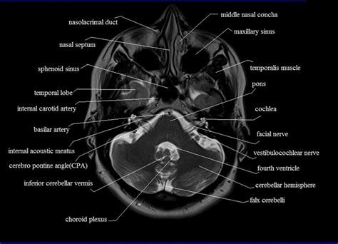 View Anatomy Cerebellum Ct Background