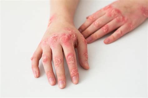 Impetigo Symptoms Treatment And Contagious Concerns