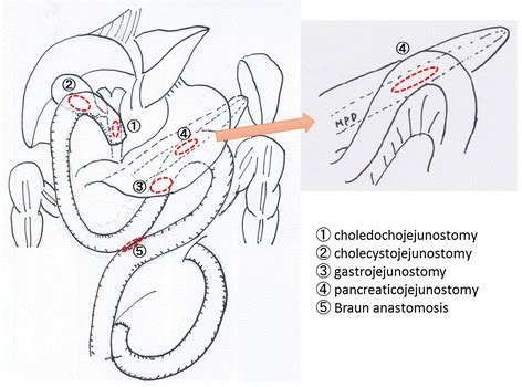 Cholecystojejunostomy