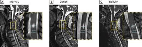 New Mri Measurements Accurately Predict Spinal Cord Injury Recovery