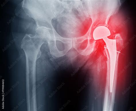 An X Ray Reveals Both Hip Joints With Total Hip Arthroplasty