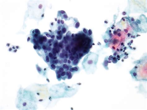 High-grade squamous intraepithelial lesion (HSIL) - Eurocytology