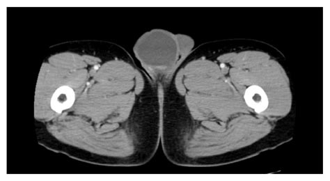 Squamous Cell Carcinoma Developing From A Testicular Epidermal Cyst A