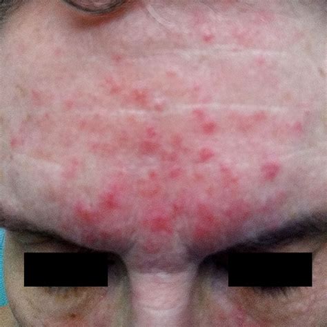 Treating Rosacea Combination Therapy Benzoyl Peroxide And The ‘stop’ Mnemonic Mdedge