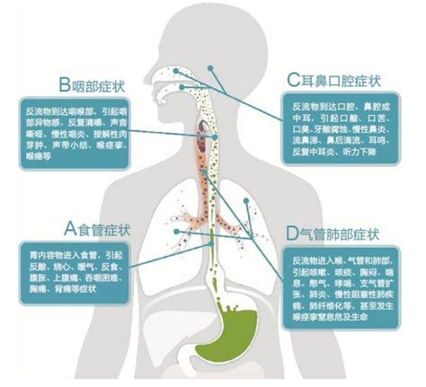 生活方式改变——预防胃食管反流病澎湃号·湃客澎湃新闻 The Paper