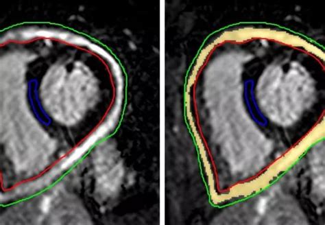 Quantitative Pericardial Dhe A Helpful Clinical Tool In Recurrent