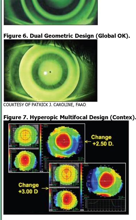 Figure 1 From An Update On Orthokeratology New Technology And Lens Designs Are Expanding The