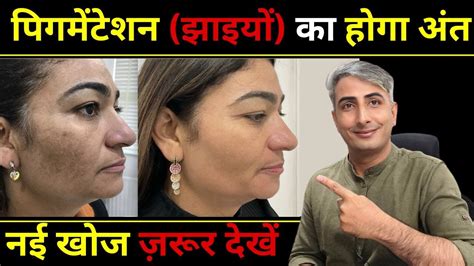 गोरी और बेदाग त्वचा पाने का राज I Secret To Fair And Flawless Skin I Dr Manoj Das Youtube