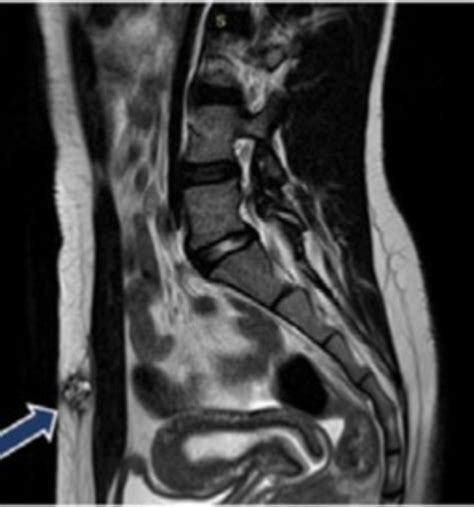 Increíble le sacan un corcho de la vagina tres años y medio después de habérsele atascado