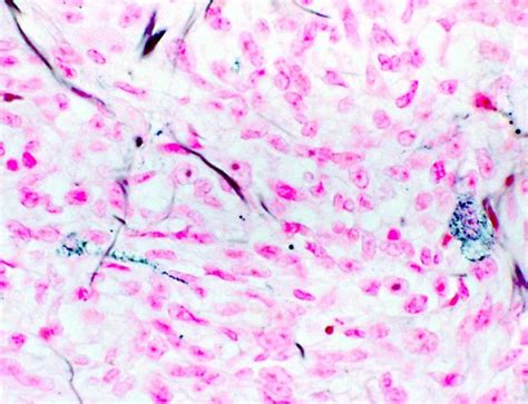 Pathology Outlines - Clear cell sarcoma