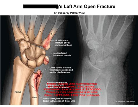 Amicus Illustration Of Amicusinjuryarmfractureopenx Raypalmar