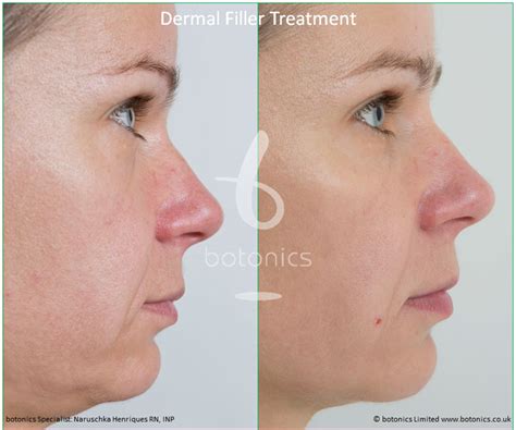 Dermal Fillers Before And After Pictures Botonics