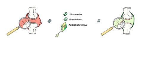 Chondropathie Arthrose La Chondropathie