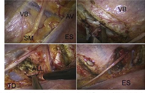 Figure From Minimalistic Thoracoscopic Anterior Spinal Release In