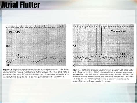 PPT Hemodynamic Monitoring In The CCU PowerPoint Presentation Free