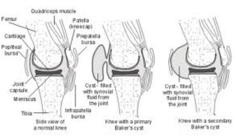 Baker's Cyst - Knee, Hip and Shoulder