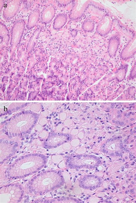 Intramucosal Signet Ring Cell Carcinoma A Typical Small Intramucosal